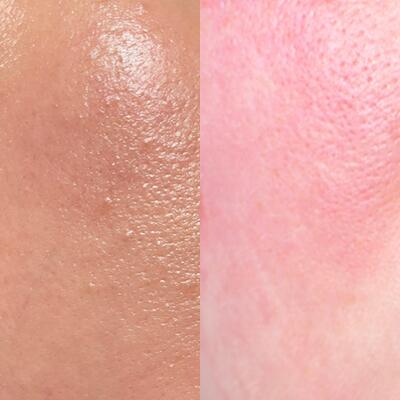 TND DEC Blog 2 5 Summer Skin Survival: How Witch Hazel Keeps You Cool, Calm and Clear TND DEC Blog 2 5