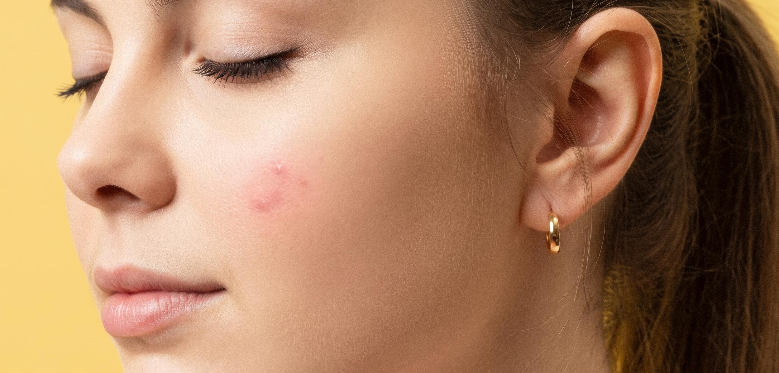 Woman with a small breakout visible on her cheek.